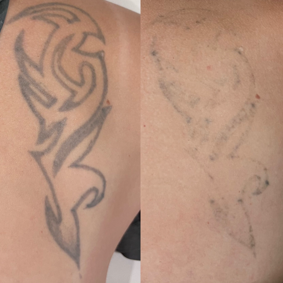 7 day healing process on this tattoo! As you can see there is a small  amount of bruising around the tattoo and a few small blisters, but ... |  Instagram